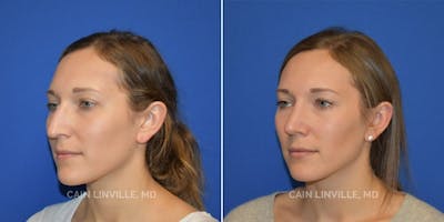 Rhinoplasty Before & After Gallery - Patient 48694025 - Image 4