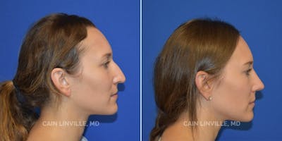 Rhinoplasty Before & After Gallery - Patient 48694025 - Image 1