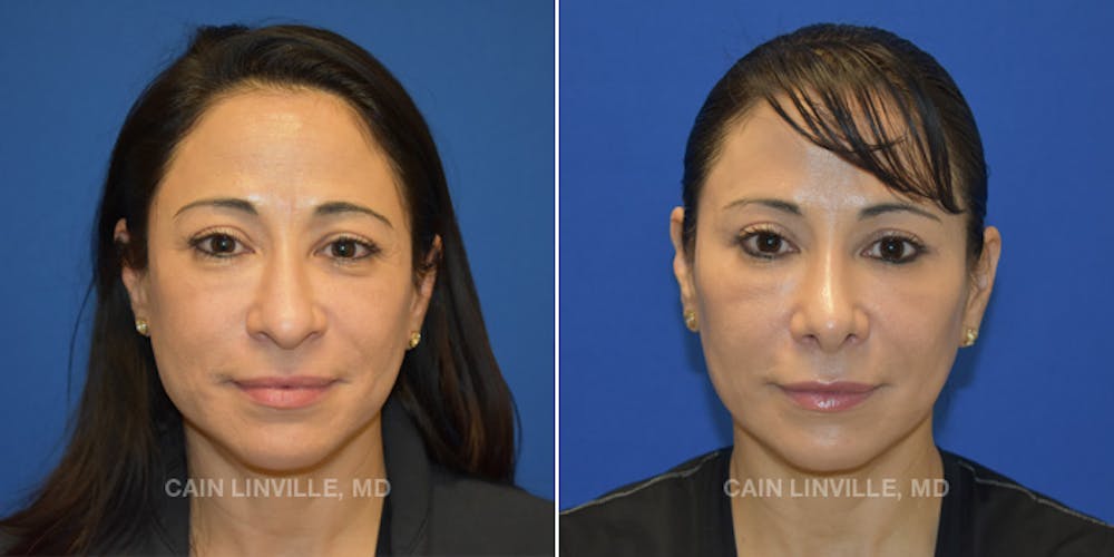 Rhinoplasty Before & After Gallery - Patient 48694026 - Image 2