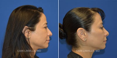 Rhinoplasty Before & After Gallery - Patient 48694026 - Image 1
