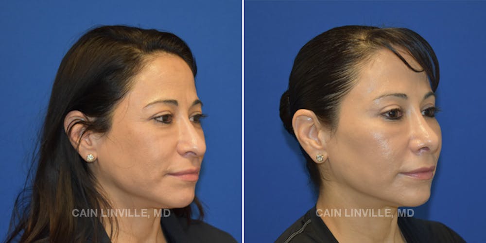 Ethnic Nose Surgery Before and After Photo Gallery - Nose Surgery Photos