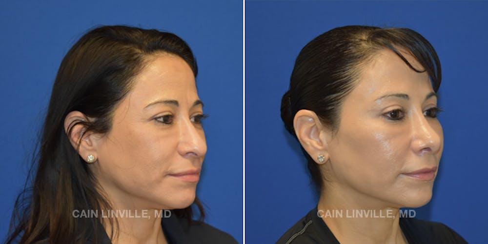 Rhinoplasty Before & After Gallery - Patient 48694026 - Image 3