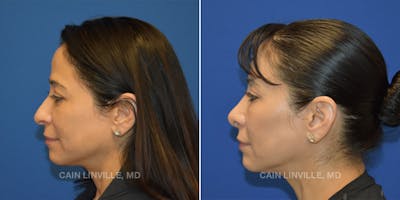 Rhinoplasty Before & After Gallery - Patient 48694026 - Image 4