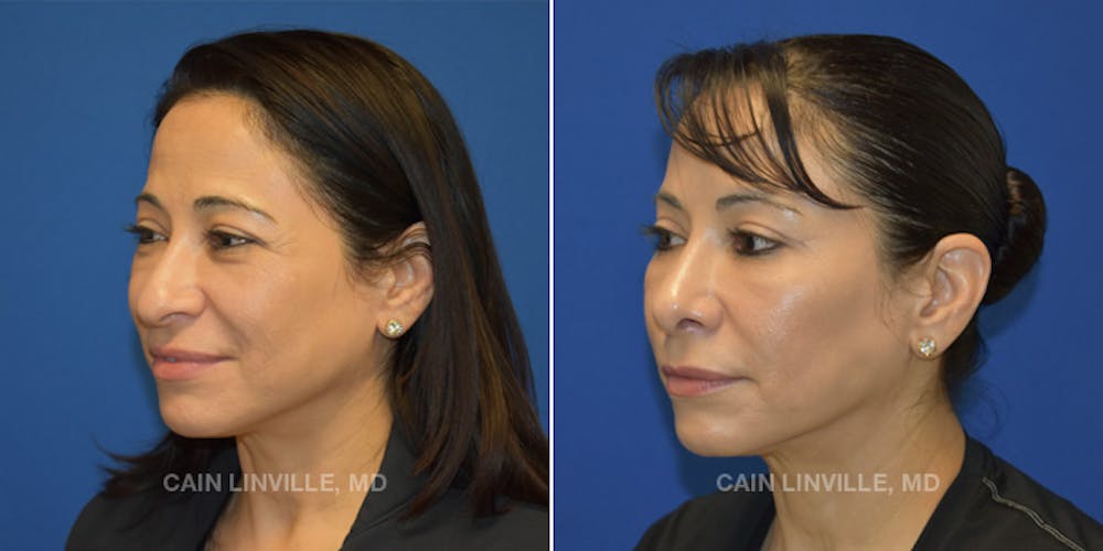 Rhinoplasty Before & After Gallery - Patient 48694026 - Image 5