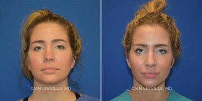 Facetite Before & After Gallery - Patient 48694045 - Image 1