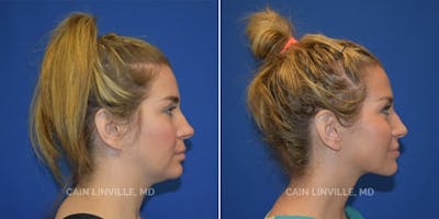 Facetite Before & After Gallery - Patient 48694045 - Image 2