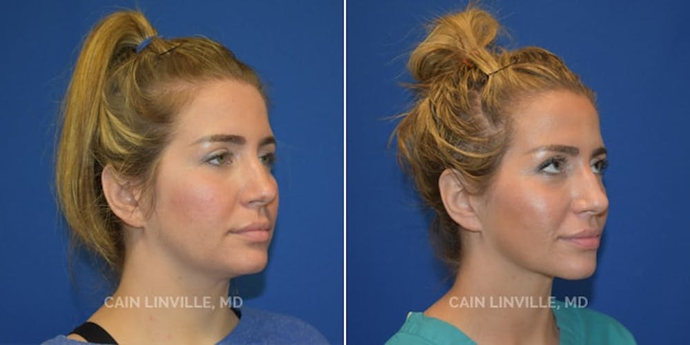 Facetite Before & After Gallery - Patient 48694045 - Image 3