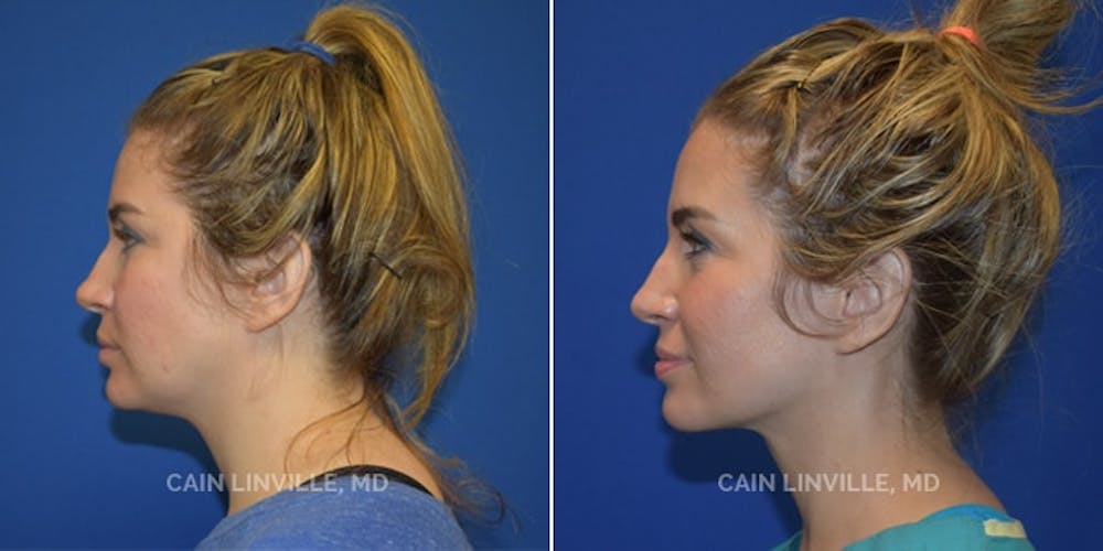Facetite Before & After Gallery - Patient 48694045 - Image 4