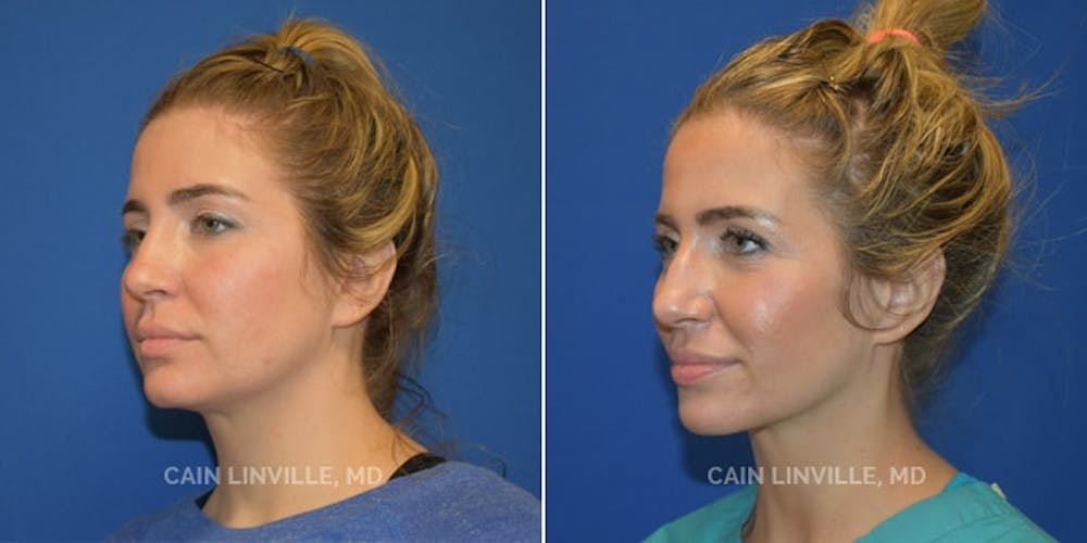 Facetite Before & After Gallery - Patient 48694045 - Image 5