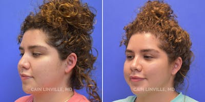 Facetite Before & After Gallery - Patient 48694046 - Image 1