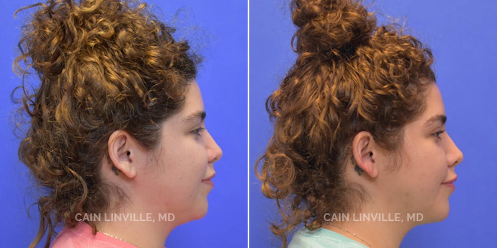 Facetite Before & After Gallery - Patient 48694046 - Image 2