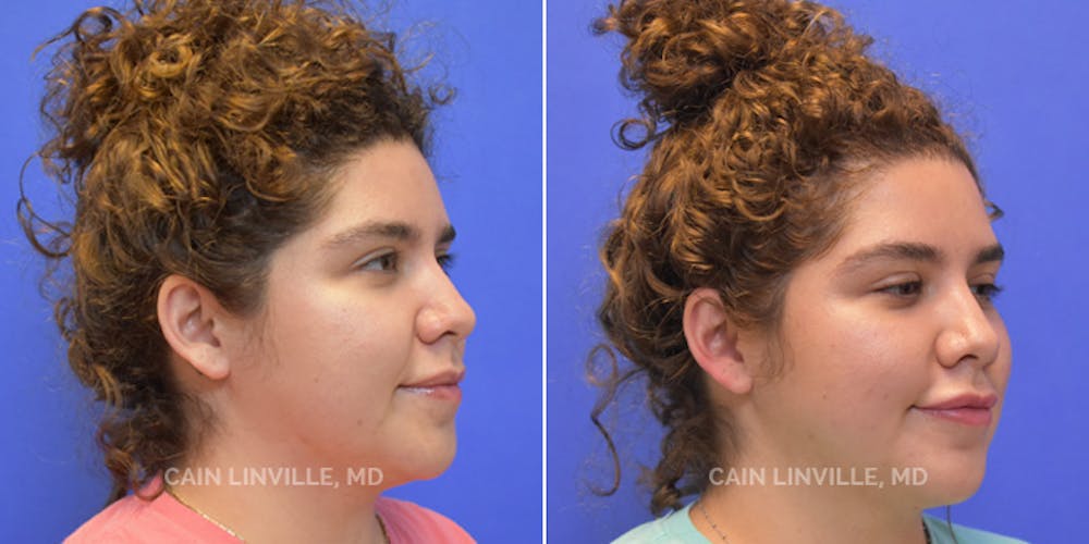 Facetite Before & After Gallery - Patient 48694046 - Image 3