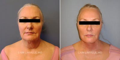 Facelift Before & After Gallery - Patient 48694054 - Image 1