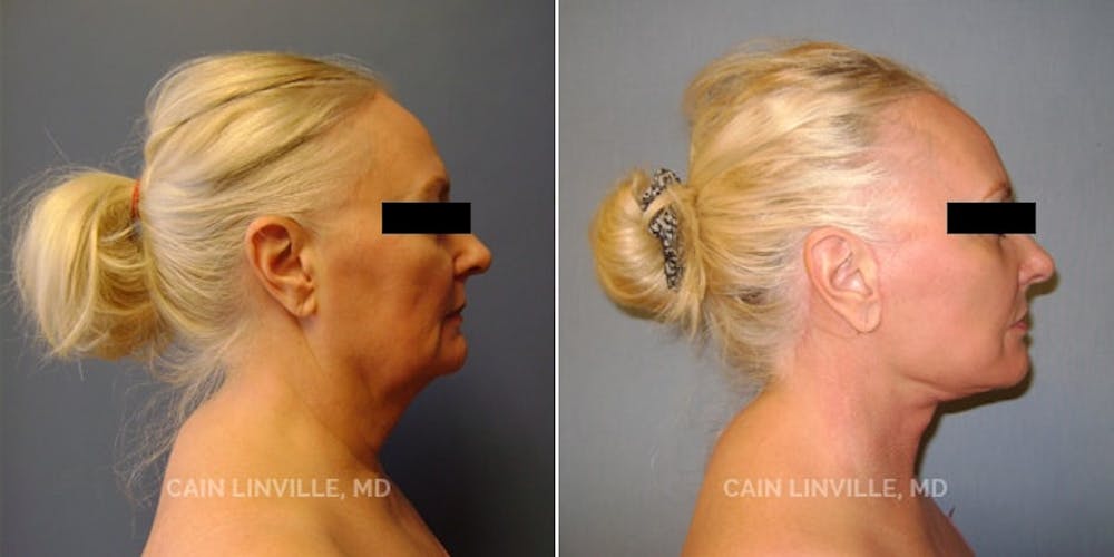 Facelift Before & After Gallery - Patient 48694054 - Image 2