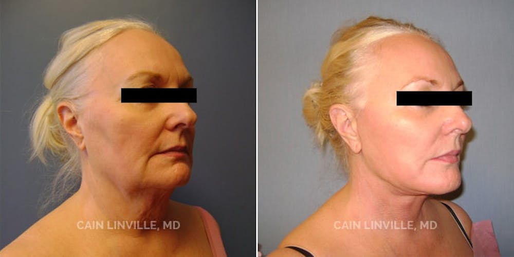 Facelift Before & After Gallery - Patient 48694054 - Image 3
