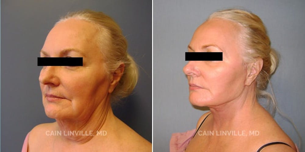 Facelift Before & After Gallery - Patient 48694054 - Image 4