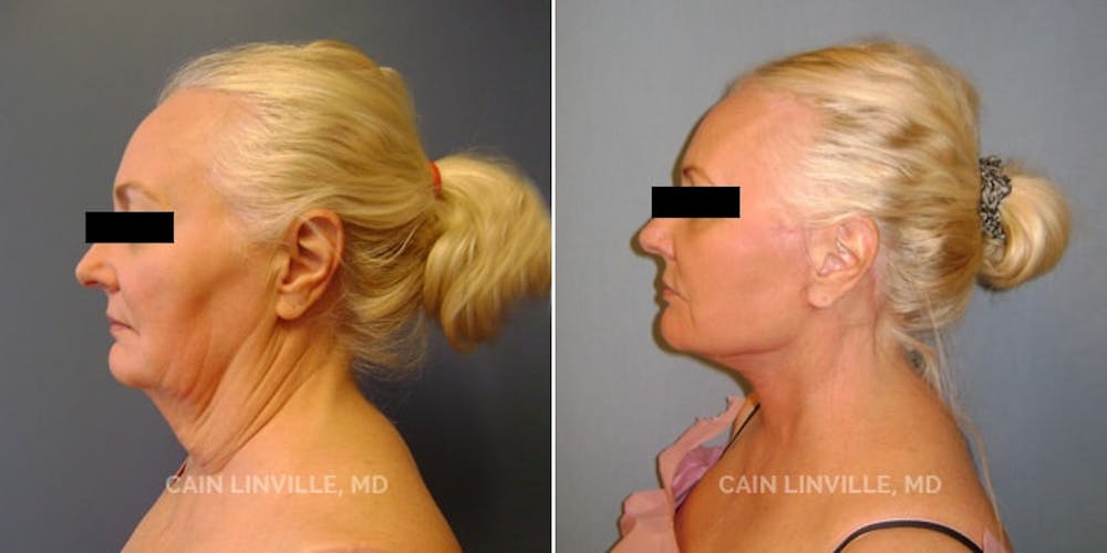 Facelift Before & After Gallery - Patient 48694054 - Image 5