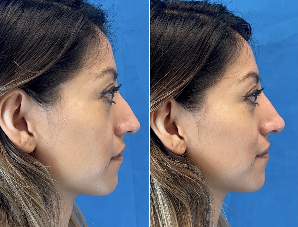 Non-Surgical Rhinoplasty Before & After Gallery - Patient 48923459 - Image 1
