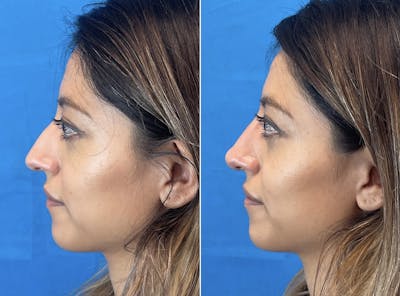 Non-Surgical Rhinoplasty Before & After Gallery - Patient 346069 - Image 2