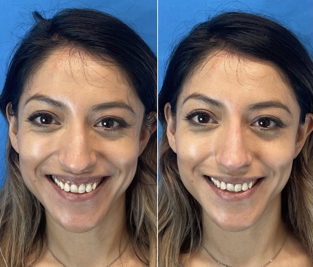 Non-Surgical Rhinoplasty Before & After Gallery - Patient 346069 - Image 3