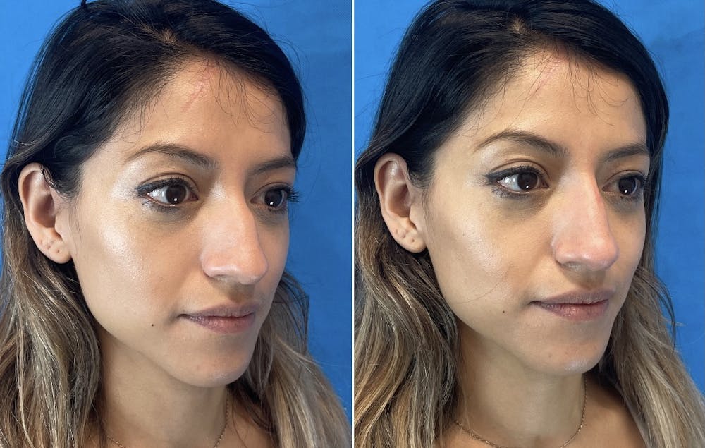 Non-Surgical Rhinoplasty Before & After Gallery - Patient 346069 - Image 4
