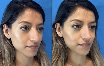 Non-Surgical Rhinoplasty Before & After Gallery - Patient 346069 - Image 4