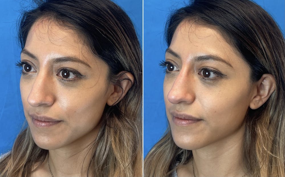 Non-Surgical Rhinoplasty Before & After Gallery - Patient 346069 - Image 5