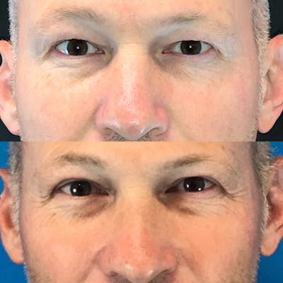 Upper Blepharoplasty Before & After Gallery - Patient 51235328 - Image 1