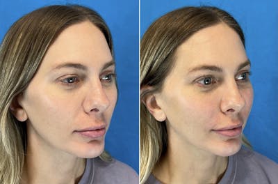 Dermal Fillers Before & After Gallery - Patient 56162535 - Image 1