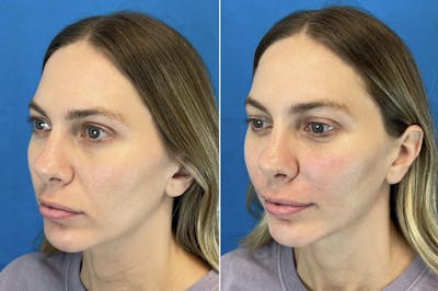 Dermal Fillers Before & After Gallery - Patient 56162535 - Image 2