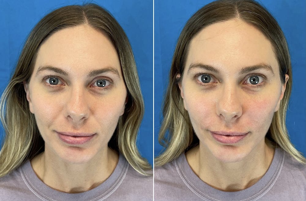 Dermal Fillers Before & After Gallery - Patient 56162535 - Image 3