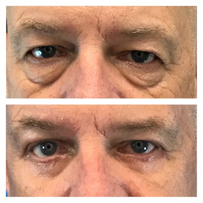 Upper Blepharoplasty Before & After Gallery - Patient 51549154 - Image 1