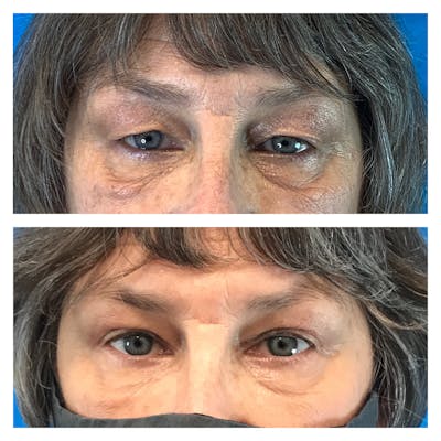 Upper Blepharoplasty Before & After Gallery - Patient 51845056 - Image 1