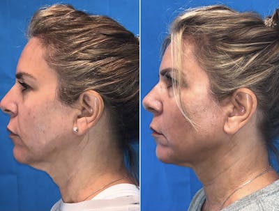 Facetite Before & After Gallery - Patient 45215485 - Image 1