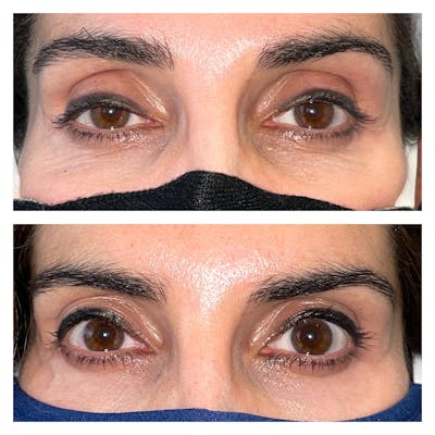 Ptosis Before & After Gallery - Patient 56709552 - Image 1