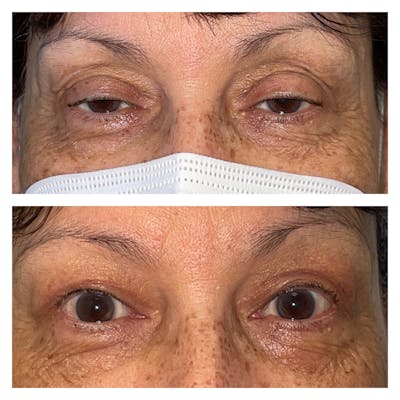 Ptosis Before & After Gallery - Patient 56709553 - Image 1