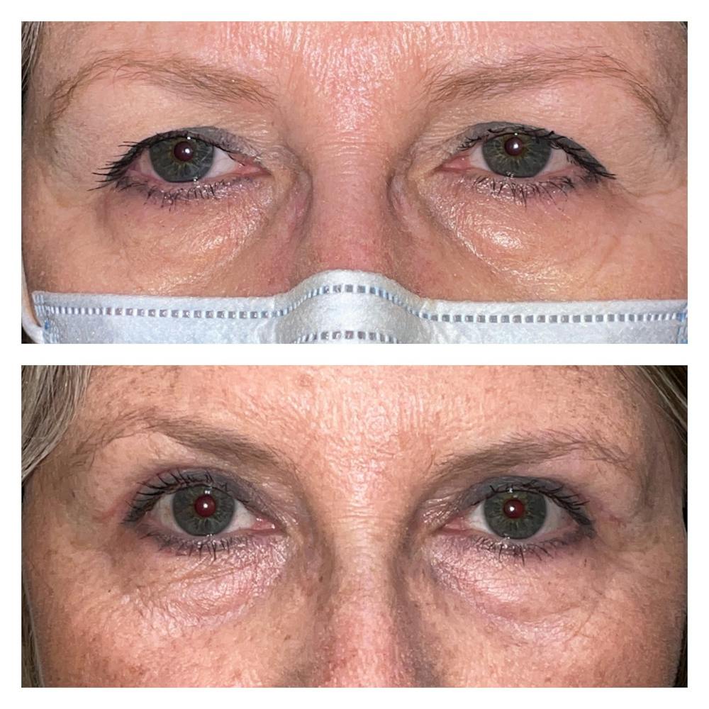 Upper Blepharoplasty Before & After Gallery - Patient 56709560 - Image 1