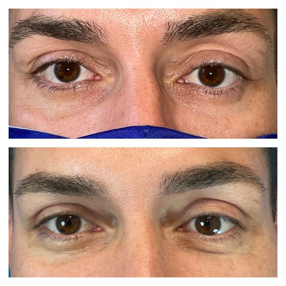 Upper Blepharoplasty Before & After Gallery - Patient 56709563 - Image 1
