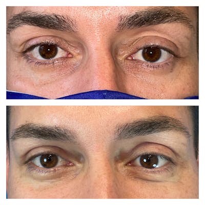 Upper Blepharoplasty Before & After Gallery - Patient 56709563 - Image 1