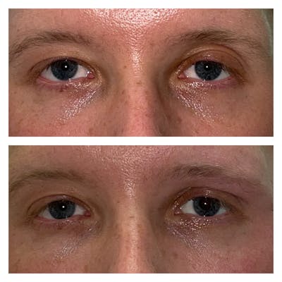 Dermal Fillers Before & After Gallery - Patient 56709574 - Image 1