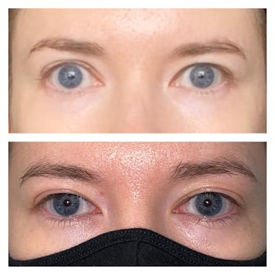 Eyelid Retraction Repair Before & After Gallery - Patient 56709579 - Image 1