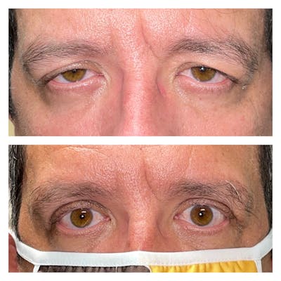 Upper Blepharoplasty Before & After Gallery - Patient 56709594 - Image 1