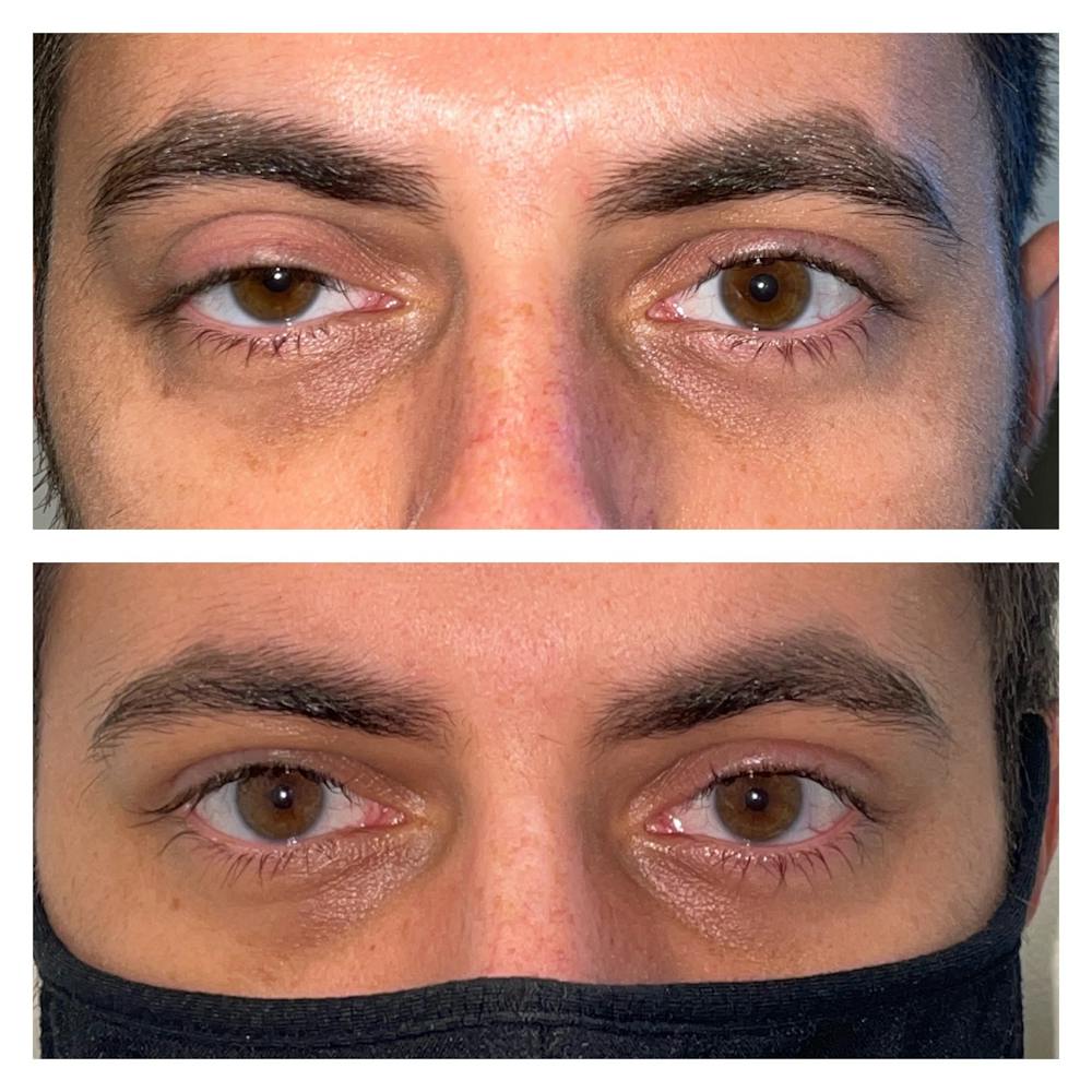 Ptosis Before & After Gallery - Patient 56709602 - Image 1