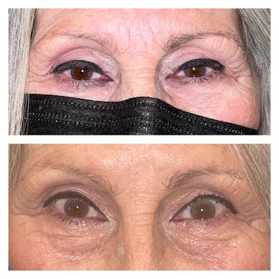 Ptosis Before & After Gallery - Patient 56709603 - Image 1