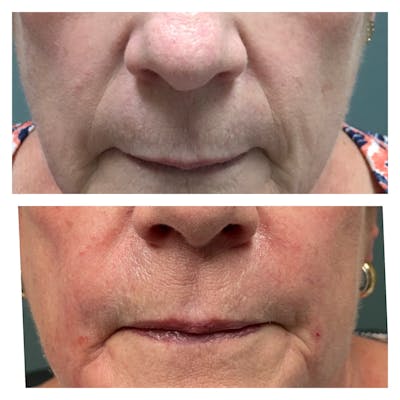 Dermal Fillers Before & After Gallery - Patient 56709750 - Image 1