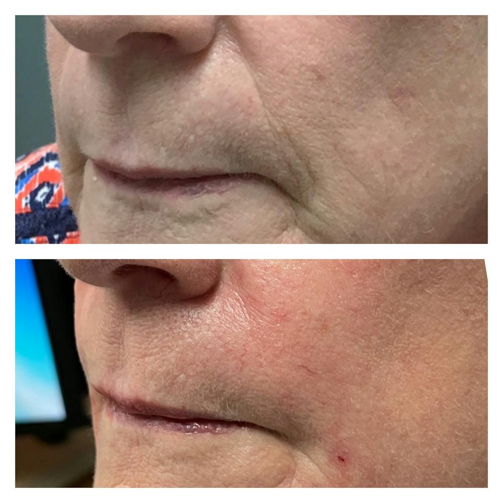 Dermal Fillers Before & After Gallery - Patient 56709750 - Image 2