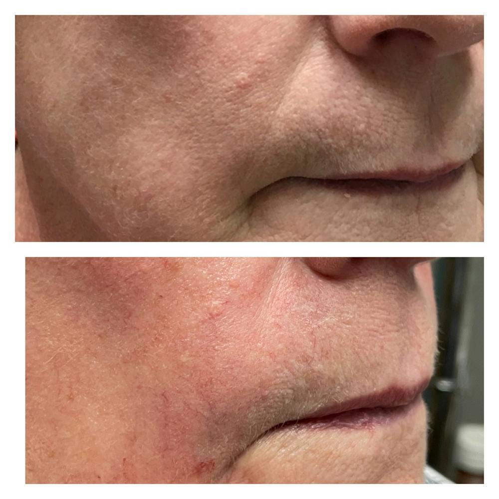 Dermal Fillers Before & After Gallery - Patient 56709750 - Image 3