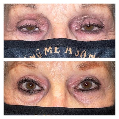 Ptosis Before & After Gallery - Patient 56709751 - Image 1