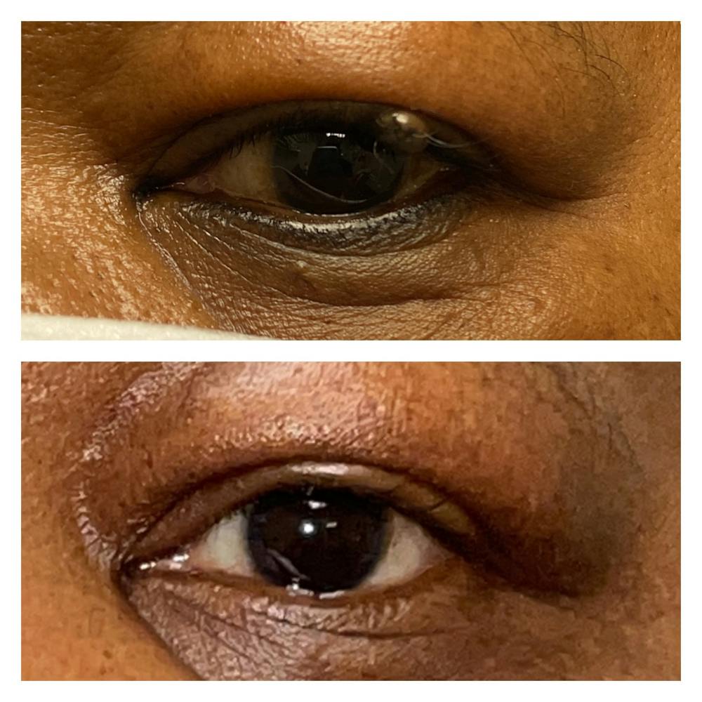 Eyelid Skin Cancer Removal (MOHS) Before & After Gallery - Patient 58007935 - Image 1