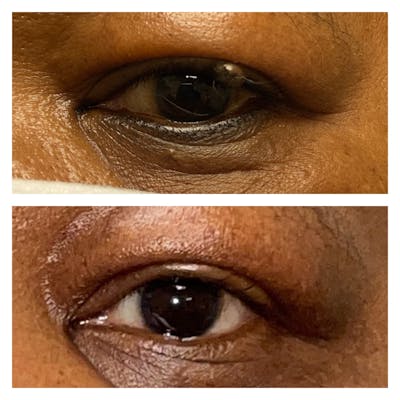Eyelid Skin Cancer Removal (MOHS) Before & After Gallery - Patient 58007935 - Image 1